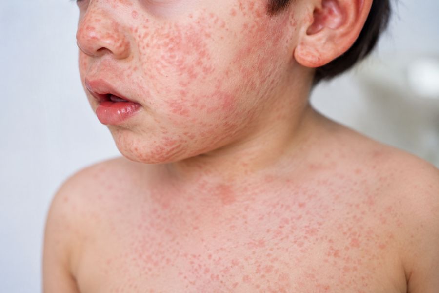 bangladesh-measles-outbreak-deaths-rise